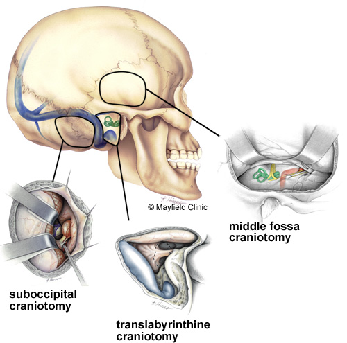 Treatment Acoustic Neuroma Association Of Canada